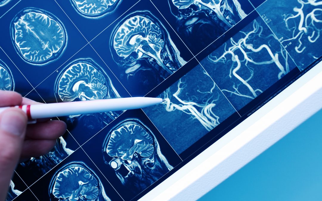 Treatment Must Be Optimized While Using Anti-Epileptic Drugs