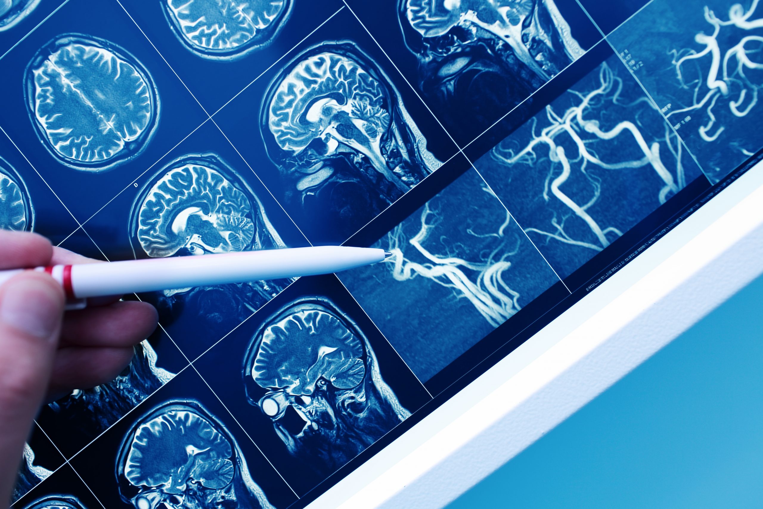 Treatment Must Be Optimized While Using Anti-Epileptic Drugs