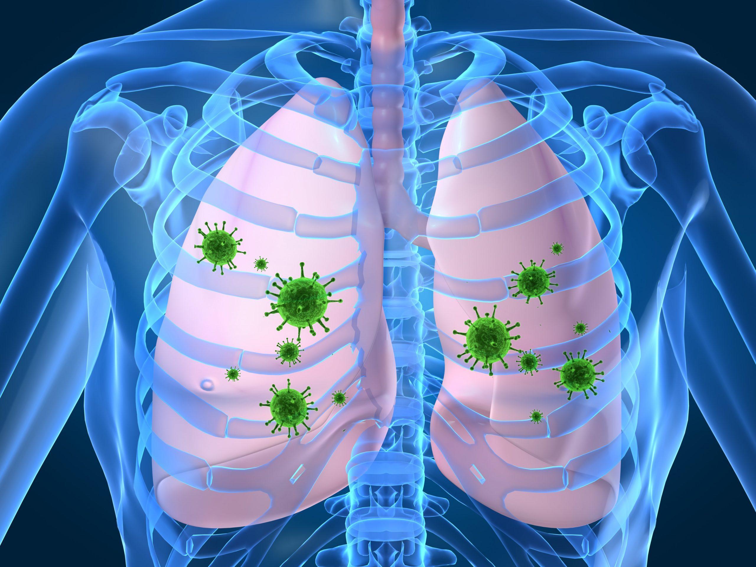 Everything you need to know about Cystic Fibrosis