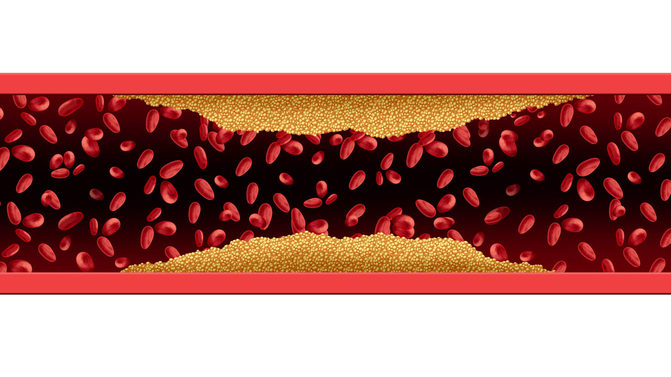 Why Dietary Cholesterol matters and how it impacts our health