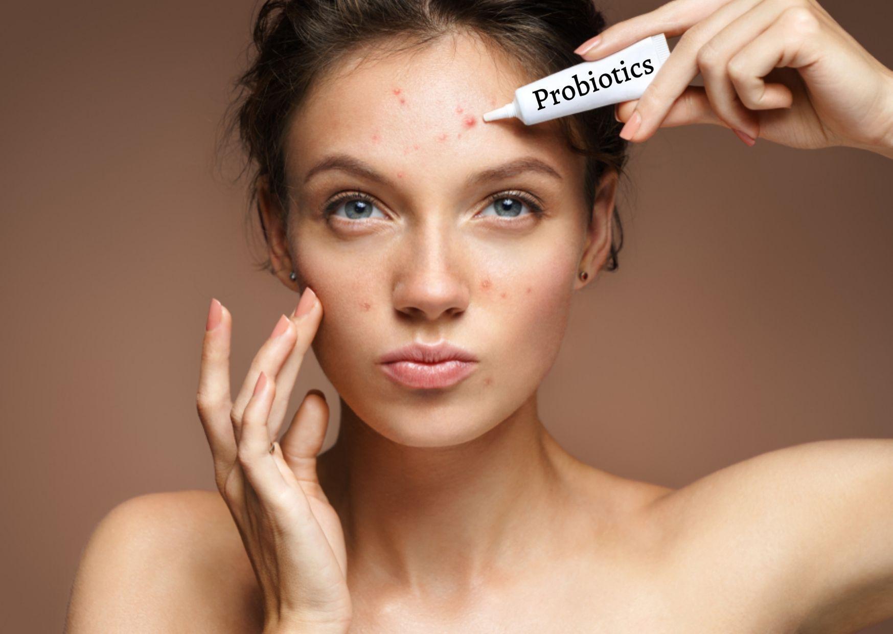 How Probiotics can fight acne and improve gut health
