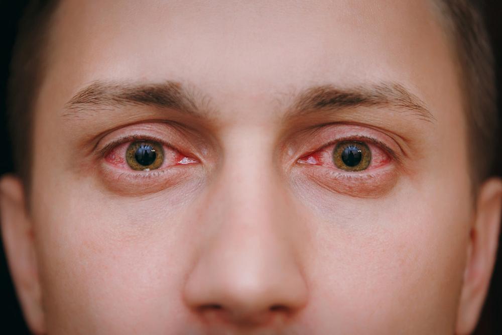 Tips for Glaucoma Patients during COVID-19