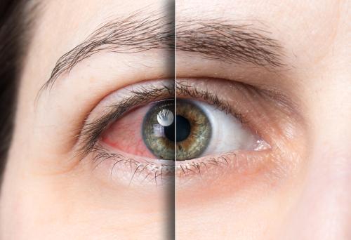 Age-related macular degeneration and how it affects old people
