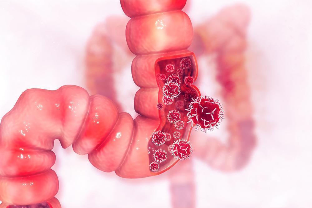 Increased risk of colon cancer in younger people has grown in recent years