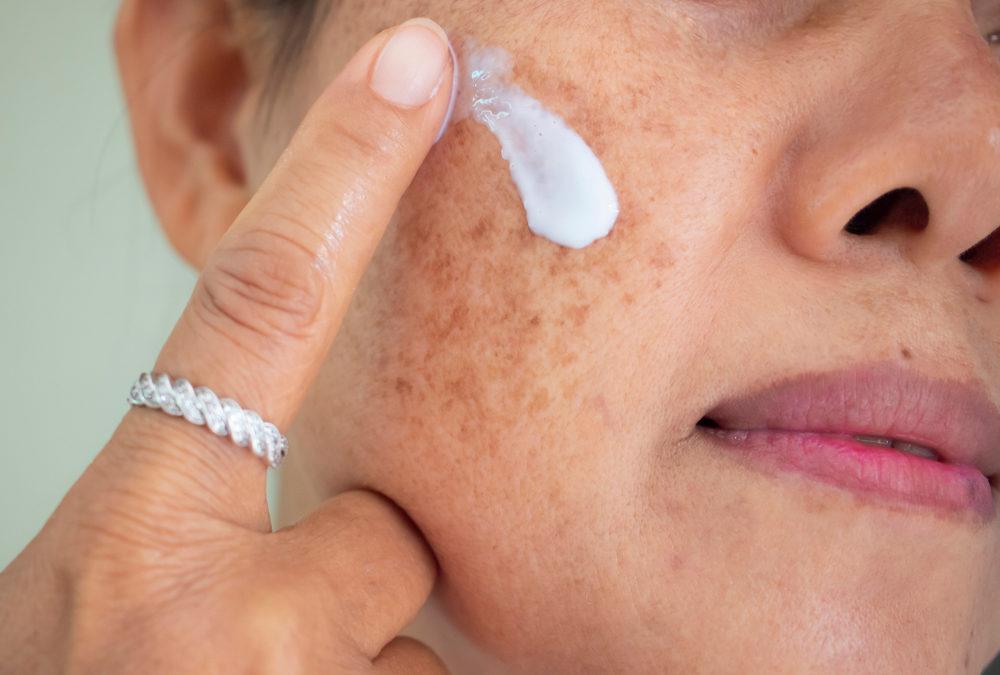 Unmasking the causes and treatments of melasma
