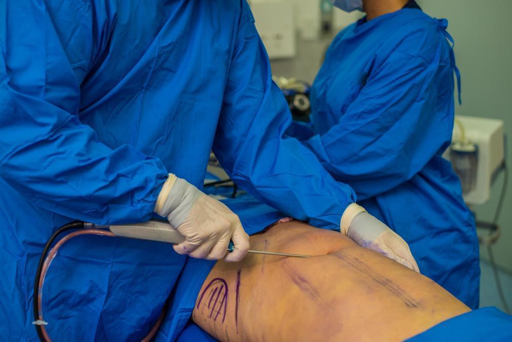 What is liposuction and how does liposuction procedure works?