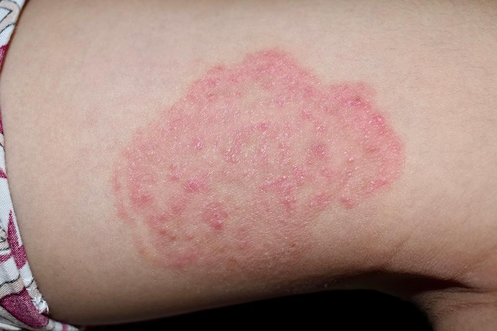 Dermatophytosis in India and management of fungal infections 