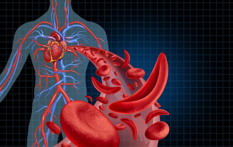 World Sickle Cell Day: What is sickle cell disease?