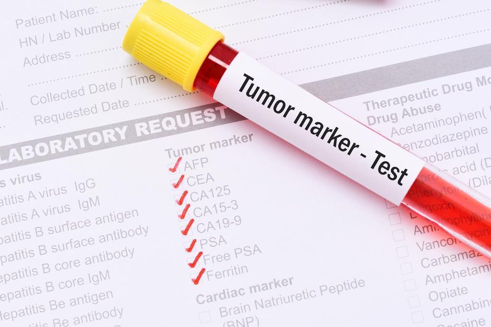 Biomarkers accelerate treatment for Lung Cancer sufferers