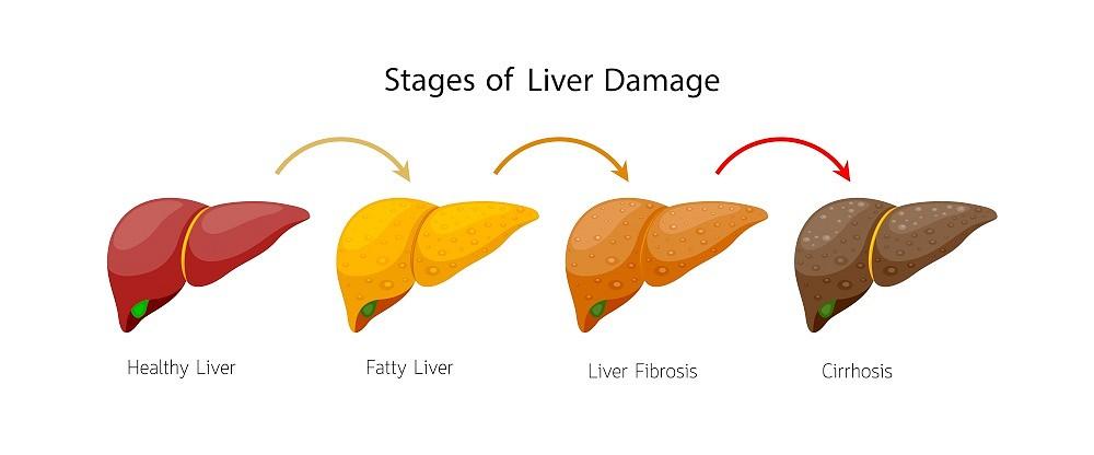 Trends in non-alcoholic fatty liver disease (NAFLD) at the global levels