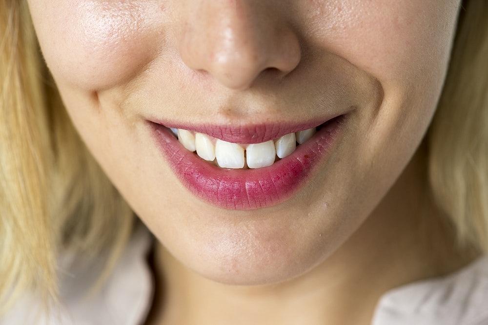 A Brief History of Dental Veneers