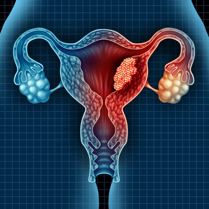 Cervical cancer in India is the most common gynecological cancer diagnosed in women