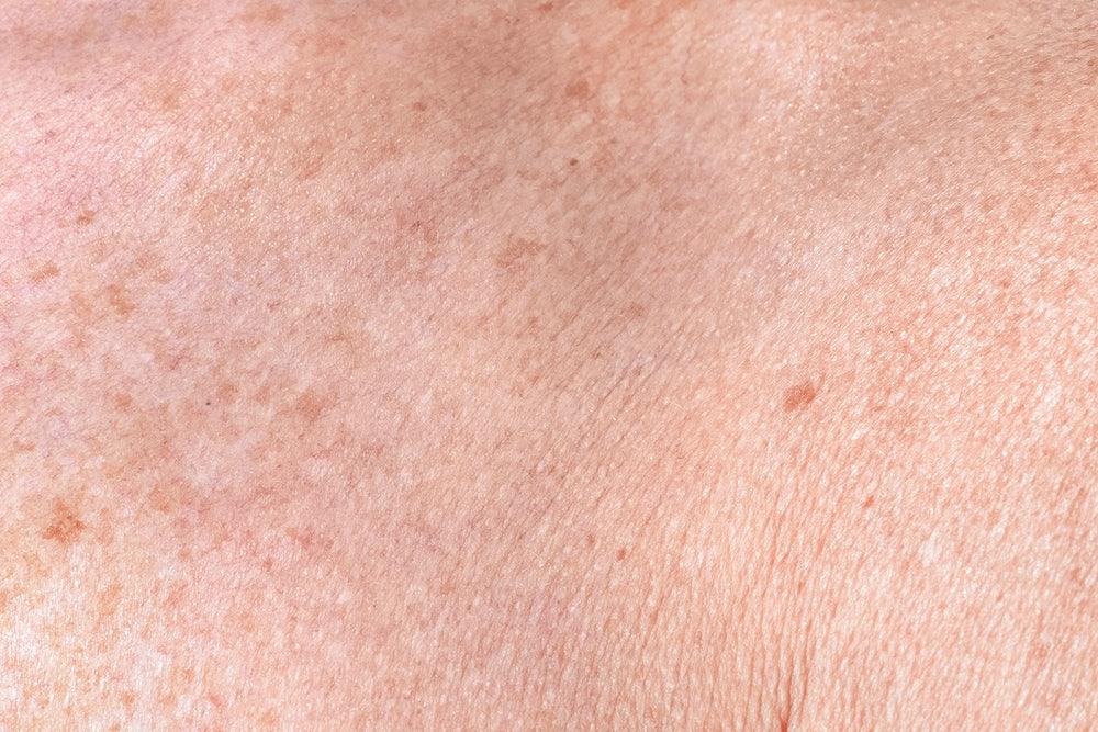 Eczema, Atopic Dermatitis and Allergies: What Is The Connection?
