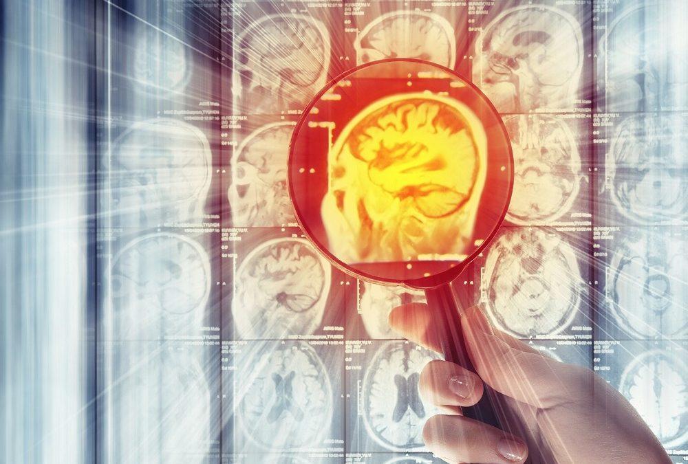 The ‘game-changing for combination drug for brain cancer treatment
