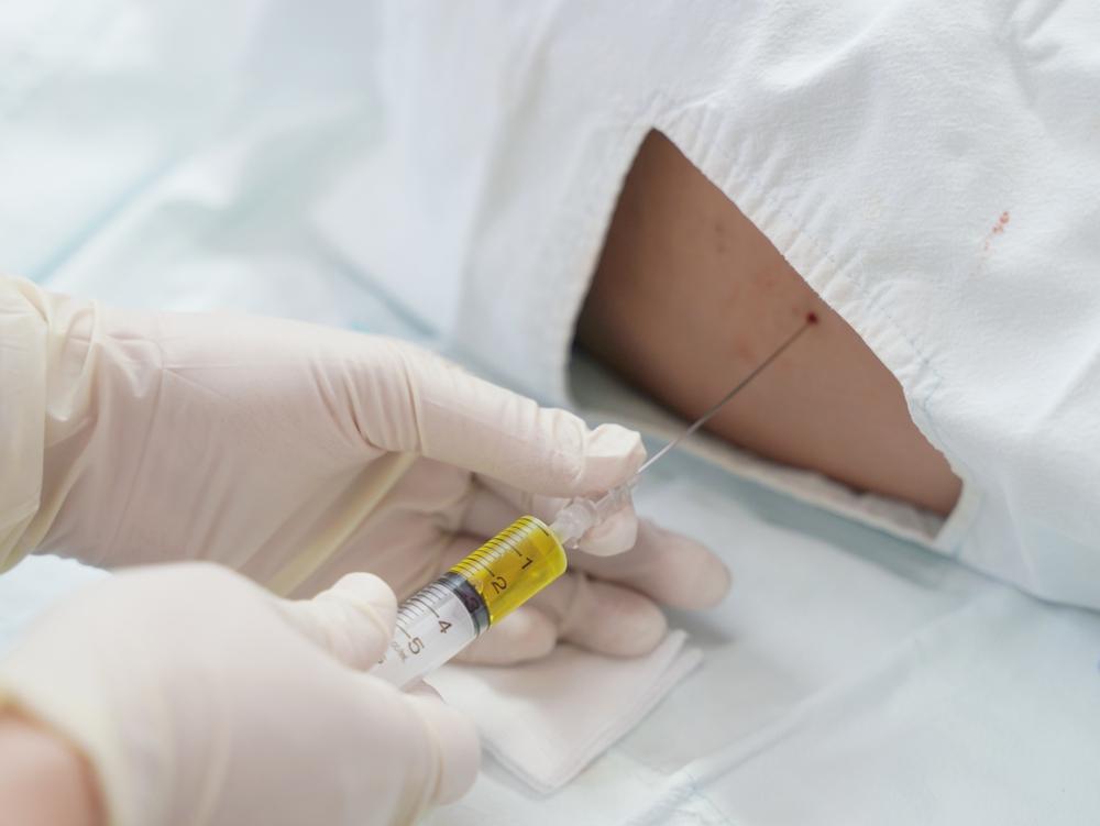 Use of intrathecal chemotherapy for cancer treatment