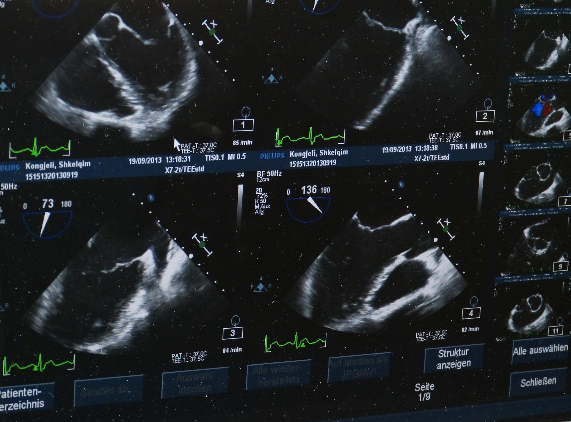 Precision Imaging Ultrasound Software Give High Image Clarity