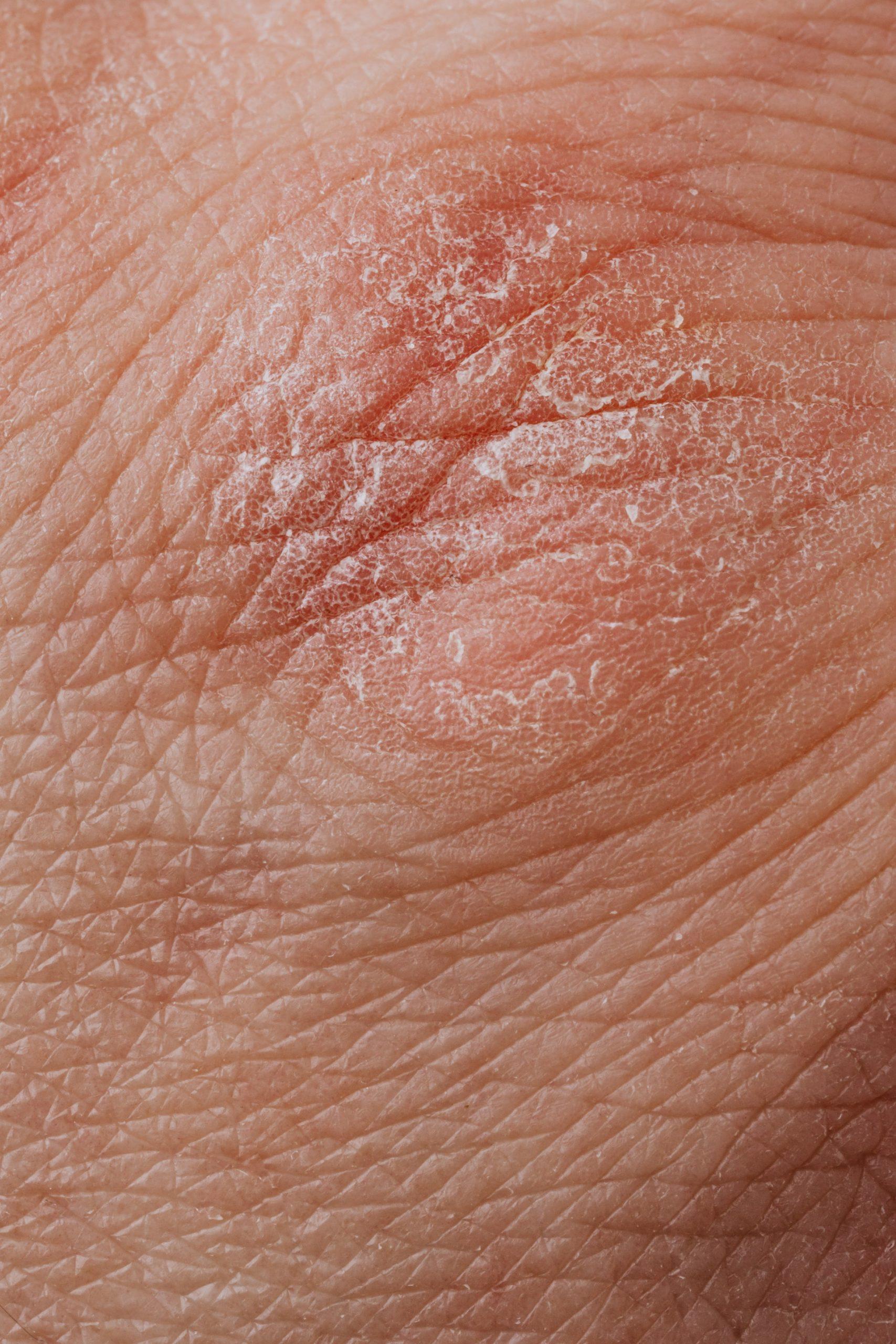 Comprehensive patch testing could benefit allergic contact dermatitis patients