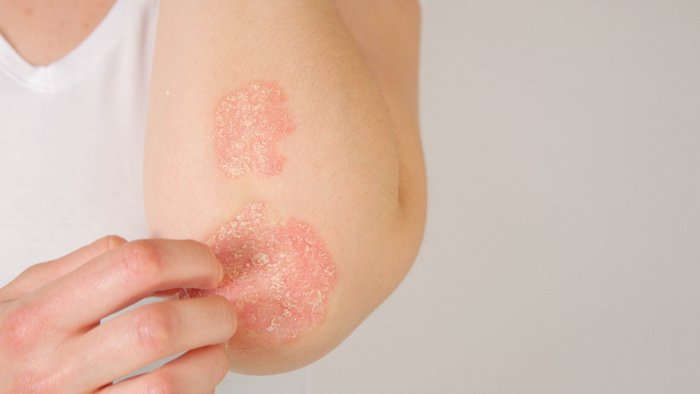Anti-tumor necrosis factor agents in psoriasis